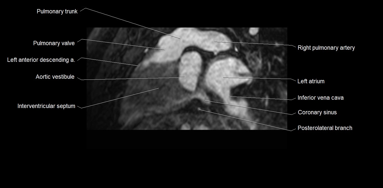 MRI heart and coronary arteries two chamber(sagittal)  anatomy image 20.webp